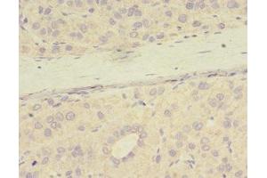 Immunohistochemistry of paraffin-embedded human liver cancer using ABIN7165968 at dilution of 1:100 (PPME1 antibody  (AA 201-386))
