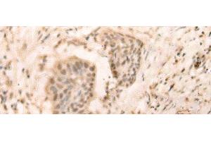 Immunohistochemistry of paraffin-embedded Human esophagus cancer tissue using ELP4 Polyclonal Antibody at dilution of 1:25(x200) (ELP4 antibody)