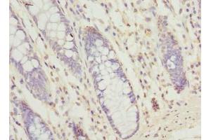 Immunohistochemistry of paraffin-embedded human colon cancer using SEC61G Antibody at a dilution of 1:100