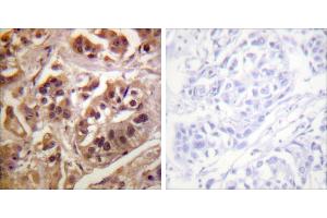 Peptide - +Immunohistochemistry analysis of paraffin-embedded human breast carcinoma tissue using GRF-1 antibody. (GRLF1 antibody)