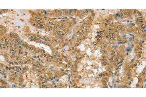 Immunohistochemistry of paraffin-embedded Human thyroid cancer using PSMC1 Polyclonal Antibody at dilution of 1:40