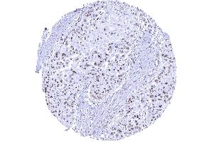 Distinct nucleolar immunostaining in the nucleoli of an esophageal squamous cell carcinoma (Recombinant Nucleolin antibody)