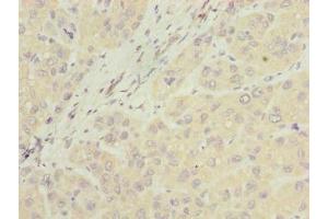 Immunohistochemistry of paraffin-embedded human liver cancer using ABIN7157067 at dilution of 1:100 (NUBPL antibody  (AA 39-319))