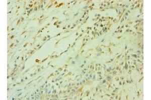 Immunohistochemistry of paraffin-embedded human breast cancer using ABIN7160470 at dilution of 1:100 (CD33 antibody  (AA 49-259))
