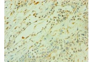 Immunohistochemistry of paraffin-embedded human breast cancer using ABIN7160470 at dilution of 1:100 (CD33 antibody  (AA 49-259))