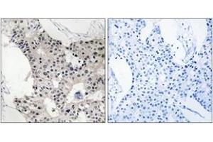 Immunohistochemistry analysis of paraffin-embedded human breast carcinoma, using BAGE4 Antibody. (BAGE4 antibody  (AA 9-58))