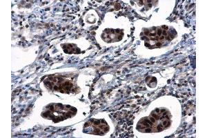IHC-P Image TSPYL1 antibody detects TSPYL1 protein at nucleus in human breast cancer by immunohistochemical analysis.