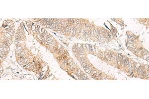 Immunohistochemistry of paraffin-embedded Human colorectal cancer tissue using TRAPPC1 Polyclonal Antibody at dilution of 1:50(x200)