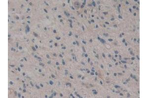 DAB staining on IHC-P; Samples: Human Glioma Tissue (CARD9 antibody  (AA 26-283))