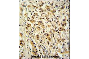 DDX49 Antibody immunohistochemistry analysis in formalin fixed and paraffin embedded human breast carcinoma followed by peroxidase conjugation of the secondary antibody and DAB staining. (DDX49 antibody  (C-Term))