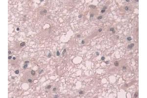 IHC-P analysis of Human Glioma Tissue, with DAB staining. (TKT antibody  (AA 1-294))