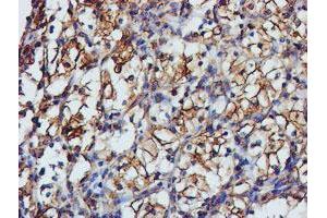 Immunohistochemical staining of paraffin-embedded Carcinoma of Human kidney tissue using anti-TUBAL3 mouse monoclonal antibody. (TUBAL3 antibody  (AA 150-446))