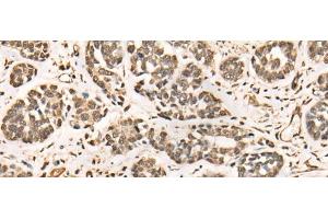 Immunohistochemistry of paraffin-embedded Human esophagus cancer tissue using BRD7 Polyclonal Antibody at dilution of 1:50(x200) (BRD7 antibody)