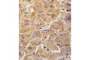 Formalin-fixed and paraffin-embedded human hepatocarcinoma tissue reacted with ALDH1A1 antibody , which was peroxidase-conjugated to the secondary antibody, followed by DAB staining.