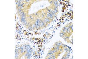 Immunohistochemistry of paraffin-embedded human colon carcinoma using MANF antibody at dilution of 1:100 (40x lens).