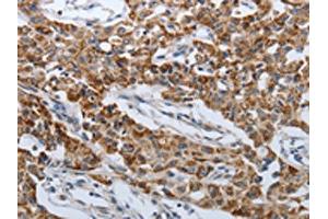 The image on the left is immunohistochemistry of paraffin-embedded Human lung cancer tissue using ABIN7192612(SPAG1 Antibody) at dilution 1/25, on the right is treated with synthetic peptide. (SPAG1 antibody)