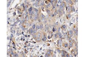 ABIN6266778 at 1/100 staining human ovarian cancer tissue sections by IHC-P.
