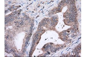 Immunohistochemical staining of paraffin-embedded Adenocarcinoma of Human ovary tissue using anti-BSG mouse monoclonal antibody. (CD147 antibody)