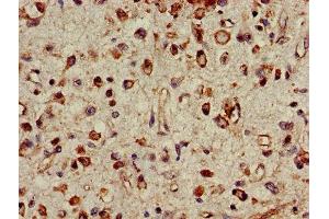 IHC image of ABIN7142234 diluted at 1:500 and staining in paraffin-embedded human glioma performed on a Leica BondTM system.