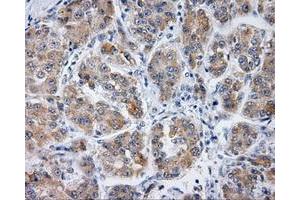 Immunohistochemical staining of paraffin-embedded Carcinoma of liver tissue using anti-PLEK mouse monoclonal antibody.
