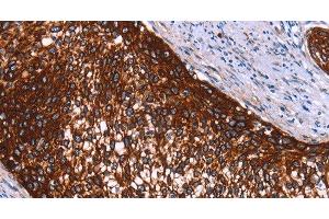 Immunohistochemistry of paraffin-embedded Human cervical cancer using HMGCS2 Polyclonal Antibody at dilution of 1:40 (HMGCS2 antibody)