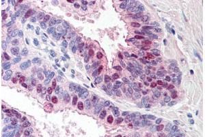 Human Prostate (formalin-fixed, paraffin-embedded) stained with TARBP1 antibody ABIN214523 at 5 ug/ml followed by biotinylated goat anti-rabbit IgG secondary antibody ABIN481713, alkaline phosphatase-streptavidin and chromogen. (TARBP1 antibody  (Internal Region))