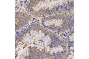 Immunohistochemistry of paraffin-embedded human rectal cancer using TNFRSF1B antibody at dilution of 1:200 (x400 lens). (TNFRSF1B antibody)
