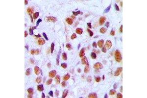 Immunohistochemical analysis of RRP8 staining in human breast cancer formalin fixed paraffin embedded tissue section.