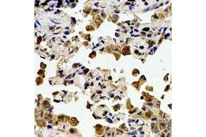Immunohistochemical analysis of Cystatin A staining in human lung cancer formalin fixed paraffin embedded tissue section. (CSTA antibody)