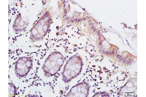 Formalin-fixed and paraffin embedded human colon carcinoma labeled with Anti-LSP1 Polyclonal Antibody, Unconjugated (ABIN755632) at 1:200 followed by conjugation to the secondary antibody and DAB staining (LSP1 antibody  (AA 241-339))