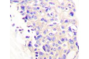 Immunohistochemistry analyzes of PLC γ1 antibody in paraffin-embedded human breast carcinoma tissue. (Phospholipase C gamma 1 antibody)