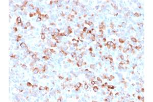 Formalin-fixed, paraffin-embedded Melanoma stained with Tyrosinase Mouse Recombinant Monoclonal Antibody (rOCA1/812). (Recombinant TYR antibody)