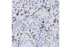 Immunohistochemistry of paraffin-embedded human gastric cancer using HDGF Antibody.