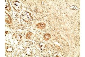 Immunohistochemistry analysis of human colon tumor tissue using Glucagon like peptide 1 pAb,  at a dilution of 1:500. (GLP-1 antibody  (AA 1-19))