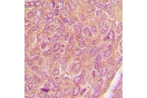 Immunohistochemical analysis of AKAP1 staining in human breast cancer formalin fixed paraffin embedded tissue section. (AKAP1 antibody)