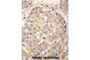 Formalin-fixed and paraffin-embedded human breast carcinoma tissue reacted with MAGEA4 polyclonal antibody  , which was peroxidase-conjugated to the secondary antibody, followed by DAB staining. (MAGEA4 antibody  (N-Term))