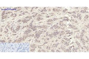 Immunohistochemistry of paraffin-embedded Human liver cancer tissue using MMP2 Polyclonal Antibody at dilution of 1:200. (MMP2 antibody)