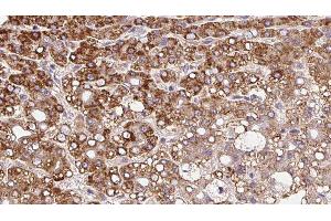 ABIN6279843 at 1/100 staining Human liver cancer tissue by IHC-P. (SLC8A1 antibody  (Internal Region))
