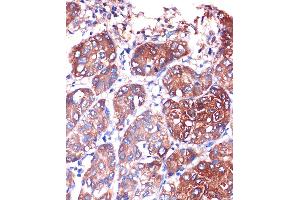 Immunohistochemistry of paraffin-embedded Human liver cancer using LYPL Rabbit pAb (ABIN1680728, ABIN3018907, ABIN3018908 and ABIN6220622) at dilution of 1:100 (40x lens). (LYPLA1 antibody  (AA 1-230))