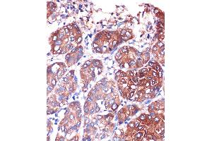 Immunohistochemistry of paraffin-embedded Human liver cancer using LYPL Rabbit pAb (ABIN1680728, ABIN3018907, ABIN3018908 and ABIN6220622) at dilution of 1:100 (40x lens). (LYPLA1 antibody  (AA 1-230))