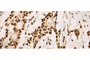 Immunohistochemistry of paraffin-embedded Human colorectal cancer tissue using ELF5 Polyclonal Antibody at dilution of 1:70(x200) (ELF5 antibody)