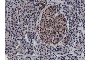 Immunohistochemical staining of paraffin-embedded Carcinoma of Human lung tissue using anti-BTN1A1 mouse monoclonal antibody.