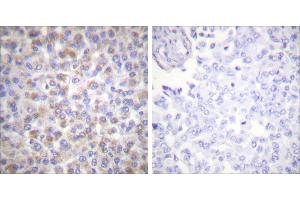 Peptide - +Immunohistochemical analysis of paraffin-embedded human breast carcinoma tissue using 14-3-3 ζ (Ab-58) antibody (#B0001). (14-3-3 zeta antibody  (Ser58))