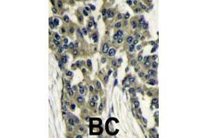 Formalin-fixed and paraffin-embedded human breast carcinoma reacted with MLST8 polyclonal antibody  , which was peroxidase-conjugated to the secondary antibody, followed by DAB staining. (GBL antibody  (Internal Region))