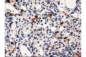 Immunohistochemical staining of paraffin-embedded Carcinoma of Human kidney tissue using anti-PRPSAP2 mouse monoclonal antibody.