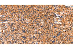 Immunohistochemistry of paraffin-embedded Human liver cancer using AMPD1 Polyclonal Antibody at dilution of 1:80 (AMPD1 antibody)