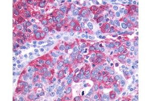Anti-GPR143 antibody IHC of human Ovary, Carcinoma. (GPR143 antibody  (C-Term))