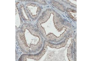 Immunohistochemical staining (Formalin-fixed paraffin-embedded sections) of human prostate cancer with OCLN monoclonal antibody, clone CL1555  shows membranous positivity in tumor cells. (Occludin antibody  (AA 282-415))