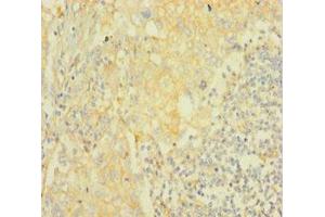 Immunohistochemistry of paraffin-embedded human lung cancer using ABIN7167028 at dilution of 1:100 (AKT2 antibody  (AA 2-481))