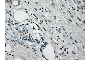 Immunohistochemical staining of paraffin-embedded Adenocarcinoma of colon tissue using anti-CRYABmouse monoclonal antibody. (CRYAB antibody)